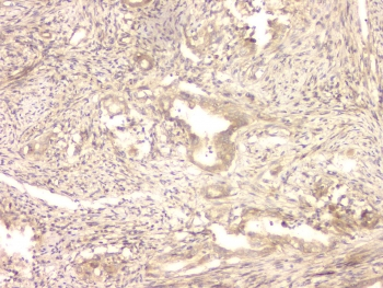 BMP15 Antibody - IHC staining of FFPE human intestinal cancer with BMP15 antibody at 1ug/ml. HIER: boil tissue sections in pH6, 10mM citrate buffer, for 10-20 min and allow to cool before testing.