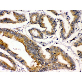 BMP2 Antibody - BMP2 antibody IHC-paraffin. IHC(P): Human Intestinal Cancer Tissue.