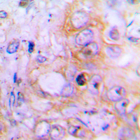 BMP2 Antibody - Immunohistochemical analysis of BMP2 staining in human lung cancer formalin fixed paraffin embedded tissue section. The section was pre-treated using heat mediated antigen retrieval with sodium citrate buffer (pH 6.0). The section was then incubated with the antibody at room temperature and detected using an HRP conjugated compact polymer system. DAB was used as the chromogen. The section was then counterstained with hematoxylin and mounted with DPX.