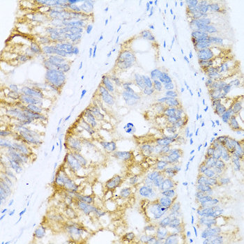 BMP2 Antibody - Immunohistochemistry of paraffin-embedded human colon carcinoma tissue.