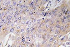 BMP3 Antibody - Immunohistochemistry analysis of BMP-3 antibody in paraffin-embedded human lung carcinoma tissue.
