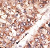 BMP3 Antibody - Formalin-fixed and paraffin-embedded human cancer tissue reacted with the primary antibody, which was peroxidase-conjugated to the secondary antibody, followed by AEC staining. This data demonstrates the use of this antibody for immunohistochemistry; clinical relevance has not been evaluated. BC = breast carcinoma; HC = hepatocarcinoma.