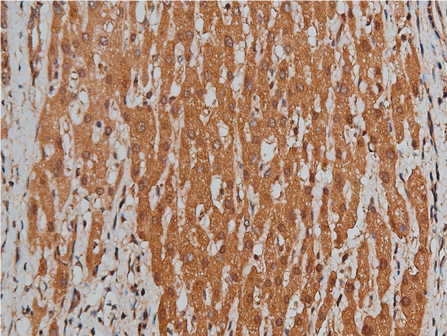 BMP3 Antibody - 1:200 staining human liver carcinoma tissues by IHC-P. The tissue was formaldehyde fixed and a heat mediated antigen retrieval step in citrate buffer was performed. The tissue was then blocked and incubated with the antibody for 1.5 hours at 22°C. An HRP conjugated goat anti-rabbit antibody was used as the secondary.