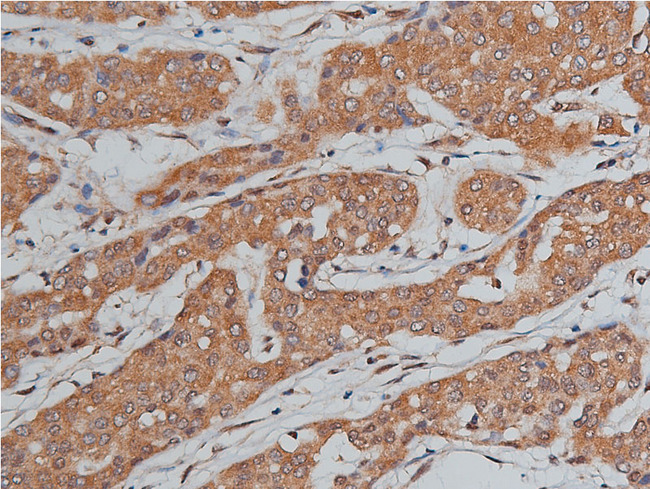 BMP3 Antibody - 1:200 staining human liver carcinoma tissues by IHC-P. The tissue was formaldehyde fixed and a heat mediated antigen retrieval step in citrate buffer was performed. The tissue was then blocked and incubated with the antibody for 1.5 hours at 22°C. An HRP conjugated goat anti-rabbit antibody was used as the secondary.