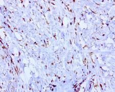 BMP4 Antibody - Immunohistochemical staining of paraffin-embedded human stomach carcinoma using BMP4 clone UMAB42, mouse monoclonal antibody at 1:100 dilution of 1mg/mL using Polink2 Broad HRP DAB for detection.requires heat-induced epitope retrieval with Accel pH8.7 at 110C for 3 min using pressure chamber/cooker. The image shows strong membranous and cytoplasmic staining.