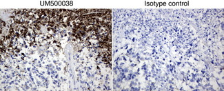 BMP4 Antibody - Immunohistochemical staining of paraffin-embedded human melanoma using anti-BMP4 mouse monoclonal antibody; an unrelated antibody of the same isotype was used as negative control. (Clone UMAB38 , dilution 1:50; heat-induced epitope retrieval by 10mM citri