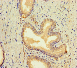 BMP4 Antibody - Immunohistochemistry of paraffin-embedded human prostate cancer using BMP4 Antibody at dilution of 1:100