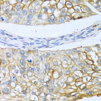 BMP4 Antibody - Immunohistochemistry of paraffin-embedded human prostate cancer using BMP4 antibody at dilution of 1:100 (40x lens).