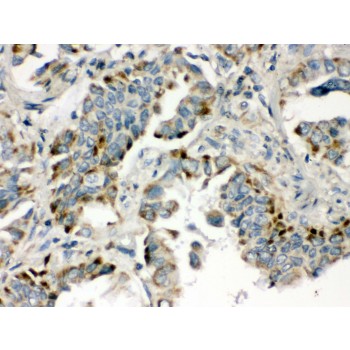 BMP5 Antibody - BMP5 antibody IHC-paraffin. IHC(P): Human Lung Cancer Tissue.