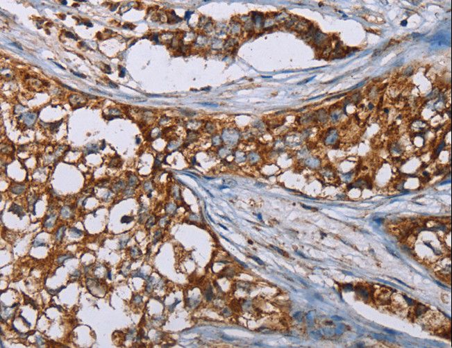 BMP6 Antibody - Immunohistochemistry of paraffin-embedded Human breast cancer using BMP6 Polyclonal Antibody at dilution of 1:50.