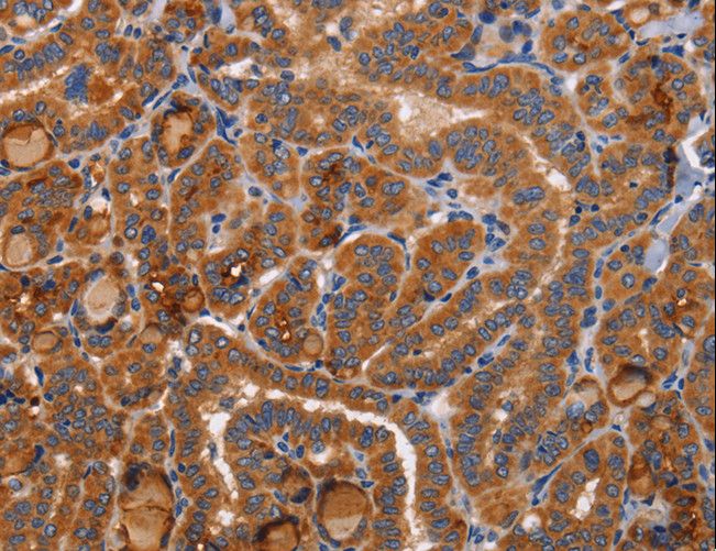 BMP6 Antibody - Immunohistochemistry of paraffin-embedded Human colon cancer using BMP6 Polyclonal Antibody at dilution of 1:40.