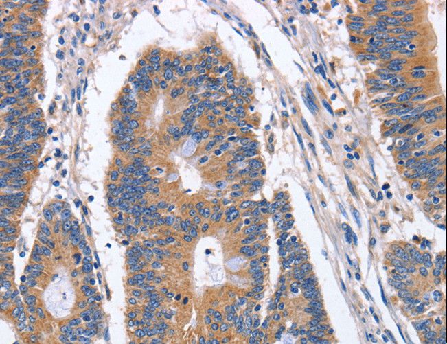 BMP6 Antibody - Immunohistochemistry of paraffin-embedded Human colon cancer using BMP6 Polyclonal Antibody at dilution of 1:40.
