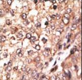 BMP7 Antibody - Formalin-fixed and paraffin-embedded human cancer tissue reacted with the primary antibody, which was peroxidase-conjugated to the secondary antibody, followed by DAB staining. This data demonstrates the use of this antibody for immunohistochemistry; clinical relevance has not been evaluated. BC = breast carcinoma; HC = hepatocarcinoma.