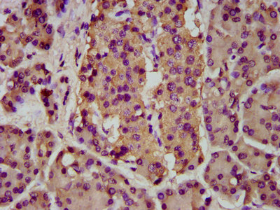 BMPER Antibody - Immunohistochemistry image at a dilution of 1:200 and staining in paraffin-embedded human pancreatic cancer performed on a Leica BondTM system. After dewaxing and hydration, antigen retrieval was mediated by high pressure in a citrate buffer (pH 6.0) . Section was blocked with 10% normal goat serum 30min at RT. Then primary antibody (1% BSA) was incubated at 4 °C overnight. The primary is detected by a biotinylated secondary antibody and visualized using an HRP conjugated SP system.