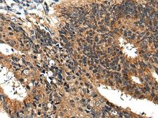 BMPER Antibody - Immunohistochemistry of paraffin-embedded Human colorectal cancer tissue  using BMPER Polyclonal Antibody at dilution of 1:40(×200)