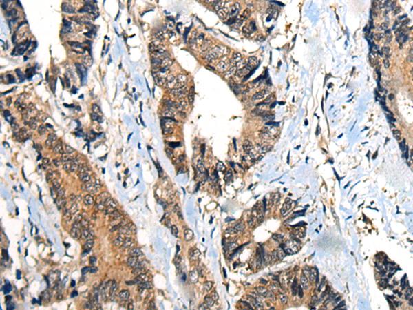 BMPER Antibody - Immunohistochemistry of paraffin-embedded Human gastric cancer tissue  using BMPER Polyclonal Antibody at dilution of 1:40(×200)