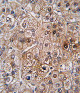BMPR2 Antibody - Formalin-fixed and paraffin-embedded human hepatocarcinoma tissue reacted with BMPR2 antibody , which was peroxidase-conjugated to the secondary antibody, followed by DAB staining. This data demonstrates the use of this antibody for immunohistochemistry; clinical relevance has not been evaluated.