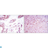 BMPR2 Antibody - Immunohistochemistry (IHC) analysis of paraffin-embedded breast cancer tissues (left) and tonsil tissues (right) with DAB staining using BMPR-II Monoclonal Antibody.