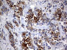 BNIP1 Antibody - IHC of paraffin-embedded Adenocarcinoma of Human breast tissue using anti-BNIP1 mouse monoclonal antibody. (Heat-induced epitope retrieval by 10mM citric buffer, pH6.0, 120°C for 3min).
