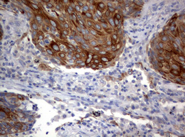 BNIP1 Antibody - IHC of paraffin-embedded Carcinoma of Human lung tissue using anti-BNIP1 mouse monoclonal antibody. (Heat-induced epitope retrieval by 10mM citric buffer, pH6.0, 120°C for 3min).