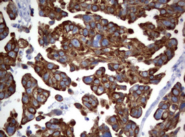 BNIP1 Antibody - IHC of paraffin-embedded Carcinoma of Human bladder tissue using anti-BNIP1 mouse monoclonal antibody.