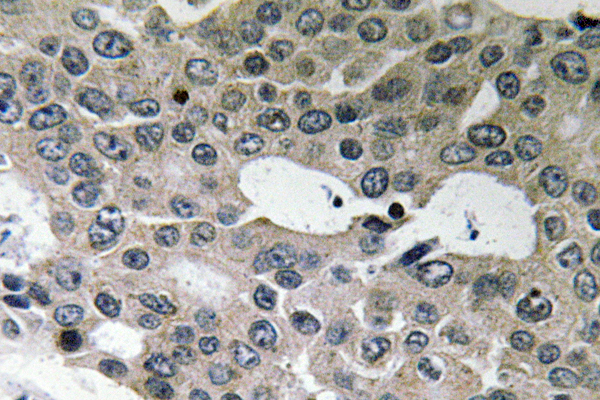 BNIP2 Antibody - Immunohistochemistry analysis of BNIP-2 antibody in paraffin-embedded human breast carcinoma tissue.