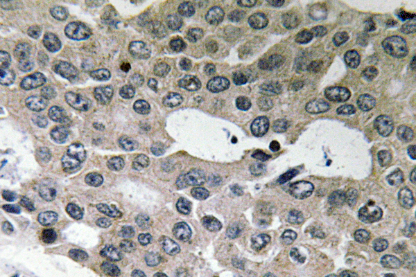 BNIP2 Antibody - IHC of BNIP-2 (E122) pAb in paraffin-embedded human breast carcinoma tissue.