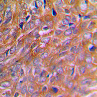 BNIP2 Antibody - Immunohistochemical analysis of BNIP2 staining in human breast cancer formalin fixed paraffin embedded tissue section. The section was pre-treated using heat mediated antigen retrieval with sodium citrate buffer (pH 6.0). The section was then incubated with the antibody at room temperature and detected using an HRP conjugated compact polymer system. DAB was used as the chromogen. The section was then counterstained with hematoxylin and mounted with DPX.