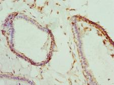 BNIP2 Antibody - Immunohistochemistry of paraffin-embedded human breast cancer at dilution 1:100