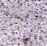 BNIPL Antibody - BNIPL antibody on lung carcinoma by IHC.