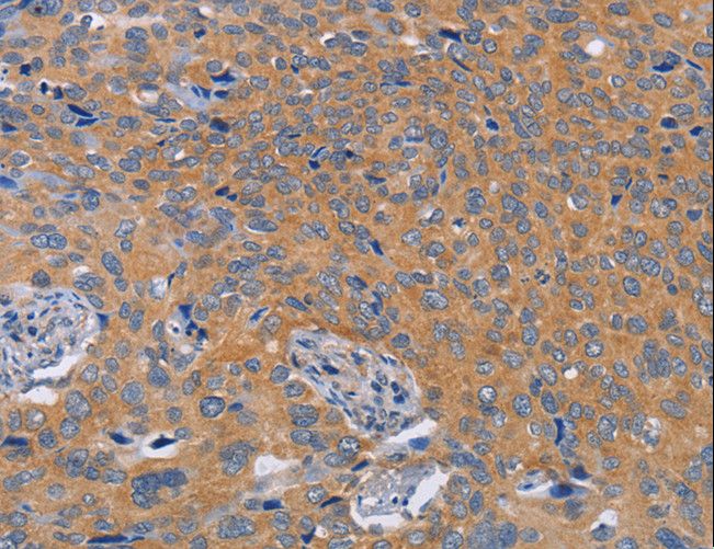 BOD1 Antibody - Immunohistochemistry of paraffin-embedded Human thyroid cancer using BOD1 Polyclonal Antibody at dilution of 1:60.