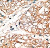 BOK Antibody - Formalin-fixed and paraffin-embedded human cancer tissue reacted with the primary antibody, which was peroxidase-conjugated to the secondary antibody, followed by DAB staining. This data demonstrates the use of this antibody for immunohistochemistry; clinical relevance has not been evaluated. BC = breast carcinoma; HC = hepatocarcinoma.