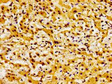 BOK Antibody - Immunohistochemistry image of paraffin-embedded human liver cancer at a dilution of 1:100