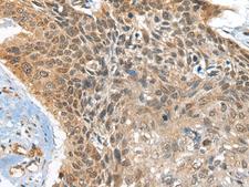 BOLA1 Antibody - Immunohistochemistry of paraffin-embedded Human esophagus cancer tissue  using BOLA1 Polyclonal Antibody at dilution of 1:35(×200)