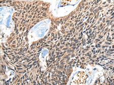 BOLA1 Antibody - Immunohistochemistry of paraffin-embedded Human esophagus cancer tissue  using BOLA1 Polyclonal Antibody at dilution of 1:50(×200)