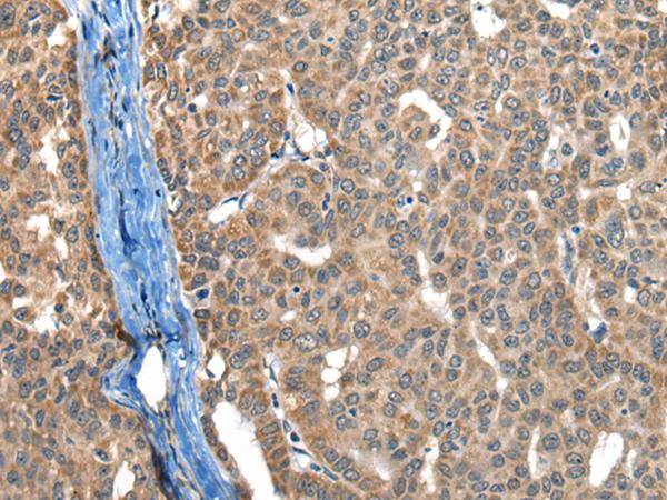 BOLA1 Antibody - Immunohistochemistry of paraffin-embedded Human liver cancer tissue  using BOLA1 Polyclonal Antibody at dilution of 1:50(×200)