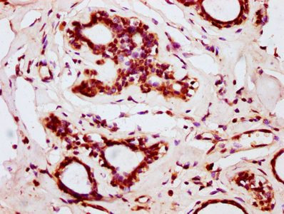 BOLA2 Antibody - Immunohistochemistry Dilution at 1:200 and staining in paraffin-embedded human breast cancer performed on a Leica BondTM system. After dewaxing and hydration, antigen retrieval was mediated by high pressure in a citrate buffer (pH 6.0). Section was blocked with 10% normal Goat serum 30min at RT. Then primary antibody (1% BSA) was incubated at 4°C overnight. The primary is detected by a biotinylated Secondary antibody and visualized using an HRP conjugated SP system.