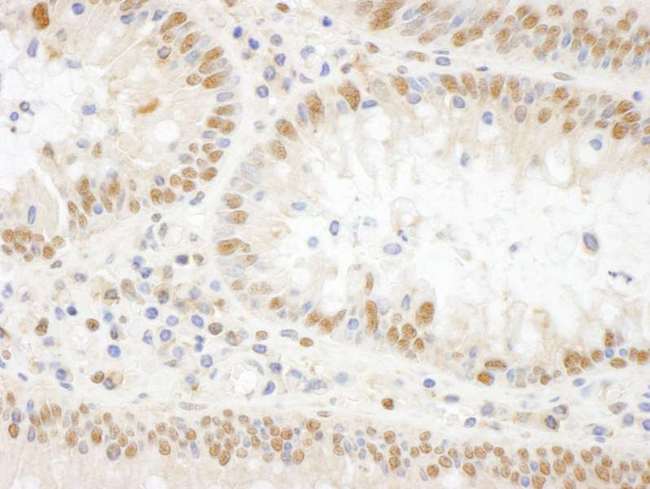 BOP1 Antibody - Detection of Human BOP1 by Immunohistochemistry. Sample: FFPE section of human colon carcinoma. Antibody: Affinity purified rabbit anti-BOP1 used at a dilution of 1:250.