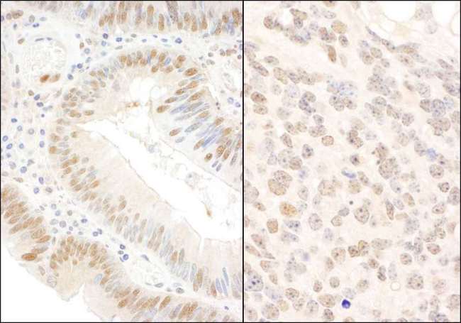 BOP1 Antibody - Detection of Human and Mouse BOP1 by Immunohistochemistry. Sample: FFPE section of human colon carcinoma (left) and mouse teratoma. Antibody: Affinity purified rabbit anti-BOP1 used at a dilution of 1:200 (1 ug/ml).