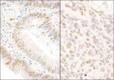 BOP1 Antibody - Detection of Human and Mouse BOP1 by Immunohistochemistry. Sample: FFPE section of human colon carcinoma (left) and mouse teratoma. Antibody: Affinity purified rabbit anti-BOP1 used at a dilution of 1:200 (1 ug/ml).