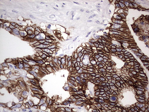 BOULE / BOLL Antibody - IHC of paraffin-embedded Adenocarcinoma of Human colon tissue using anti-BOLL mouse monoclonal antibody. (Heat-induced epitope retrieval by 1 mM EDTA in 10mM Tris, pH8.5, 120°C for 3min).