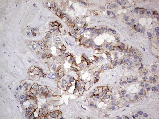 BOULE / BOLL Antibody - IHC of paraffin-embedded Carcinoma of Human liver tissue using anti-BOLL mouse monoclonal antibody. (Heat-induced epitope retrieval by 1 mM EDTA in 10mM Tris, pH8.5, 120°C for 3min).