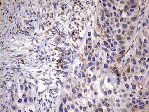 BOULE / BOLL Antibody - IHC of paraffin-embedded Carcinoma of Human kidney tissue using anti-BOLL mouse monoclonal antibody. (Heat-induced epitope retrieval by 1 mM EDTA in 10mM Tris, pH8.5, 120°C for 3min).
