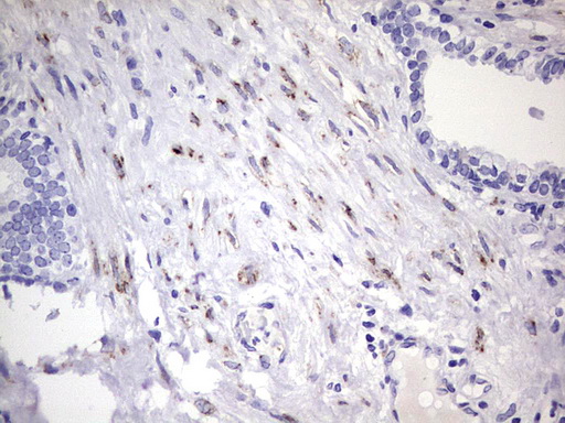 BOULE / BOLL Antibody - IHC of paraffin-embedded Carcinoma of Human prostate tissue using anti-BOLL mouse monoclonal antibody. (Heat-induced epitope retrieval by 1 mM EDTA in 10mM Tris, pH8.5, 120°C for 3min).
