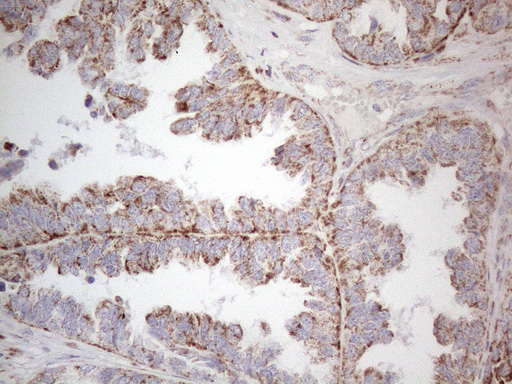 BP1 / DLX4 Antibody - Immunohistochemical staining of paraffin-embedded Adenocarcinoma of Human ovary tissue using anti-DLX4 mouse monoclonal antibody. (Heat-induced epitope retrieval by 1mM EDTA in 10mM Tris buffer. (pH8.5) at 120°C for 3 min. (1:150)