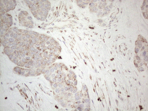 BP1 / DLX4 Antibody - Immunohistochemical staining of paraffin-embedded Adenocarcinoma of Human endometrium tissue using anti-DLX4 mouse monoclonal antibody. (Heat-induced epitope retrieval by 1mM EDTA in 10mM Tris buffer. (pH8.5) at 120°C for 3 min. (1:150)