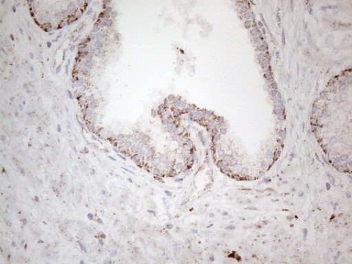 BP1 / DLX4 Antibody - Immunohistochemical staining of paraffin-embedded Carcinoma of Human prostate tissue using anti-DLX4 mouse monoclonal antibody. (Heat-induced epitope retrieval by 1mM EDTA in 10mM Tris buffer. (pH8.5) at 120°C for 3 min. (1:150)