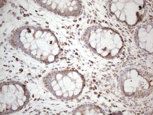BP1 / DLX4 Antibody - Immunohistochemical staining of paraffin-embedded Human colon tissue within the normal limits using anti-DLX4 mouse monoclonal antibody. (Heat-induced epitope retrieval by 1mM EDTA in 10mM Tris buffer. (pH8.5) at 120°C for 3 min. (1:150)