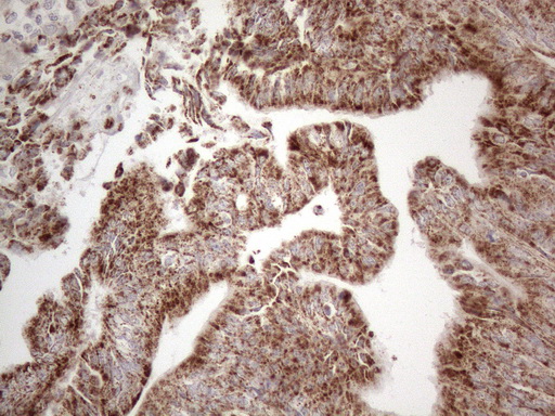 BP1 / DLX4 Antibody - Immunohistochemical staining of paraffin-embedded Adenocarcinoma of Human colon tissue using anti-DLX4 mouse monoclonal antibody. (Heat-induced epitope retrieval by 1mM EDTA in 10mM Tris buffer. (pH8.5) at 120°C for 3 min. (1:150)