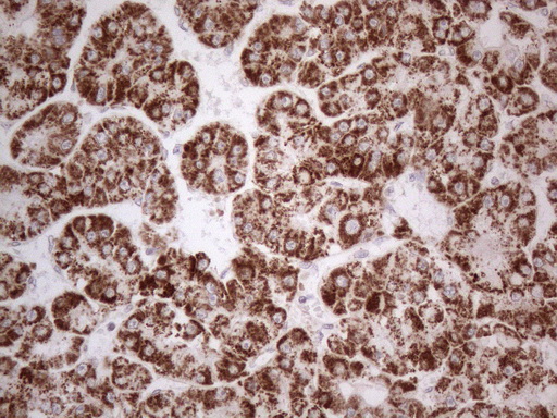 BP1 / DLX4 Antibody - Immunohistochemical staining of paraffin-embedded Carcinoma of Human liver tissue using anti-DLX4 mouse monoclonal antibody. (Heat-induced epitope retrieval by 1mM EDTA in 10mM Tris buffer. (pH8.5) at 120°C for 3 min. (1:150)